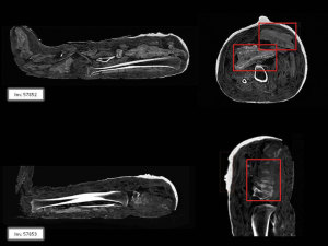 By using imaging technology and other state-of-the-art lab tests, Vatican experts discovered it was a fake mummy made up of a few human bones from the Middle Ages wrapped in ancient bandages. Such fakes were often passed off to unsuspecting European collectors during the so-called "mummy-mania" of the 19th century.